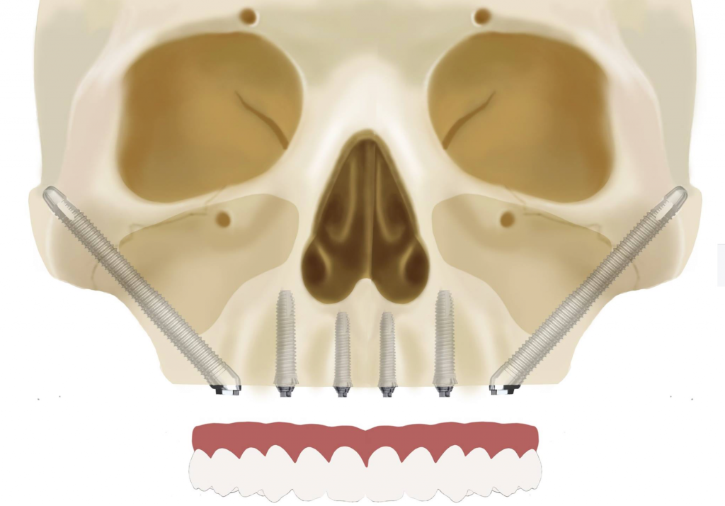 What Are Zygomatic Implants? Swiss Dental Center