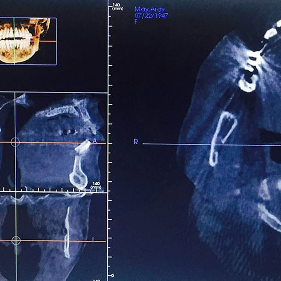 Precision at Every Step