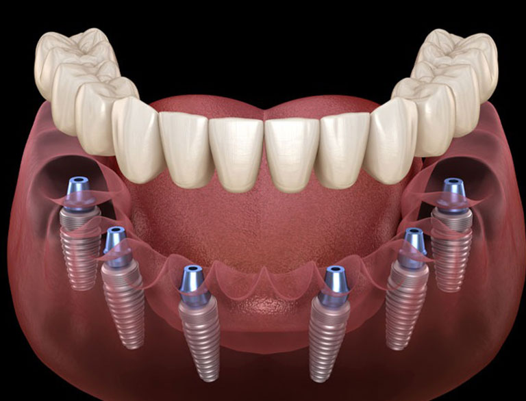Fixed vs. Removable Implant Solutions