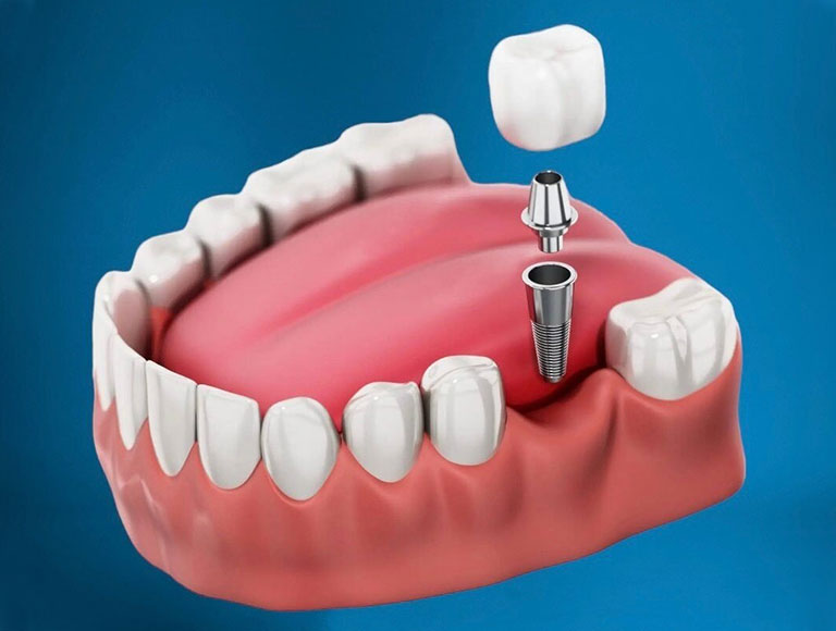 Teeth-In-A-Day Solutions