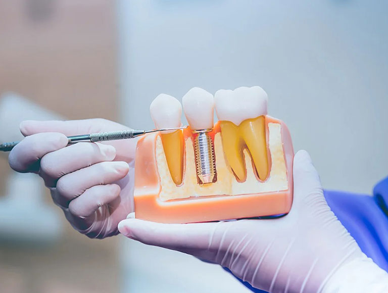 Benefits of Swiss Choice Implants: